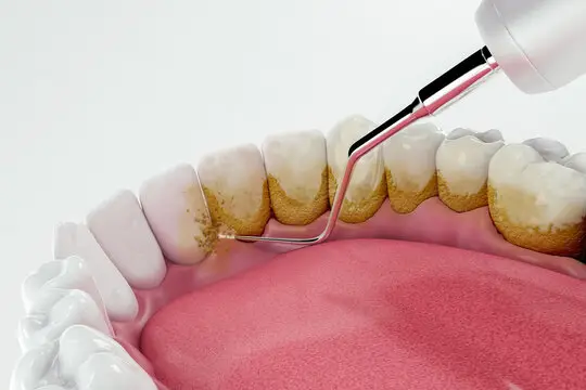 deep cleanning srp braces extraction tooth extract pulled out partial dentures removable root canal dentures composite resin inlay onlay bridge crowns Invisalign clear aligners teeth reshaping gummy smile botox bonding teeth whitening miami best dentist straight teeth white teeth perfect teeth beautiful smile veneers smile design veneers