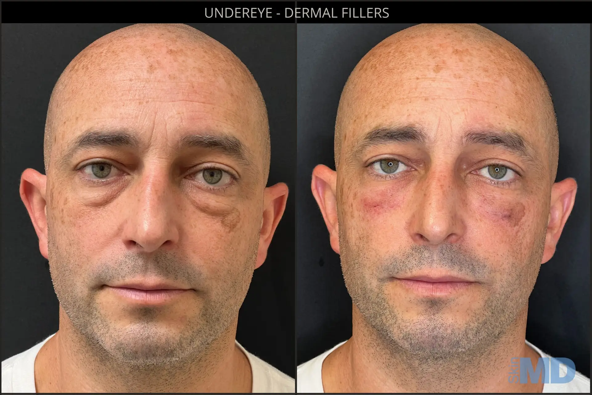 dermal fillers botox deep cleanning srp braces extraction tooth extract pulled out partial dentures removable root canal dentures composite resin inlay onlay bridge crowns Invisalign clear aligners teeth reshaping gummy smile botox bonding teeth whitening miami best dentist straight teeth white teeth perfect teeth beautiful smile veneers smile design veneers