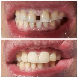 composite resin inlay onlay bridge crowns Invisalign clear aligners teeth reshaping gummy smile botox bonding teeth whitening miami best dentist straight teeth white teeth perfect teeth beautiful smile veneers smile design veneers