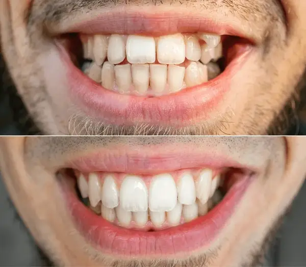 braces extraction tooth extract pulled out partial dentures removable root canal dentures composite resin inlay onlay bridge crowns Invisalign clear aligners teeth reshaping gummy smile botox bonding teeth whitening miami best dentist straight teeth white teeth perfect teeth beautiful smile veneers smile design veneers