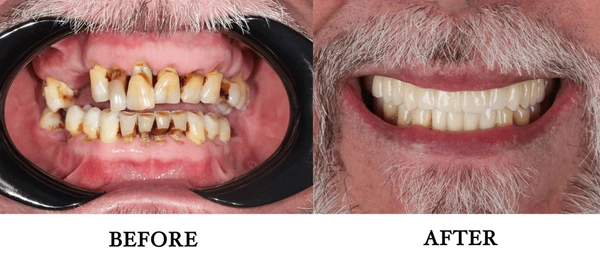 root canal dentures composite resin inlay onlay bridge crowns Invisalign clear aligners teeth reshaping gummy smile botox bonding teeth whitening miami best dentist straight teeth white teeth perfect teeth beautiful smile veneers smile design veneers