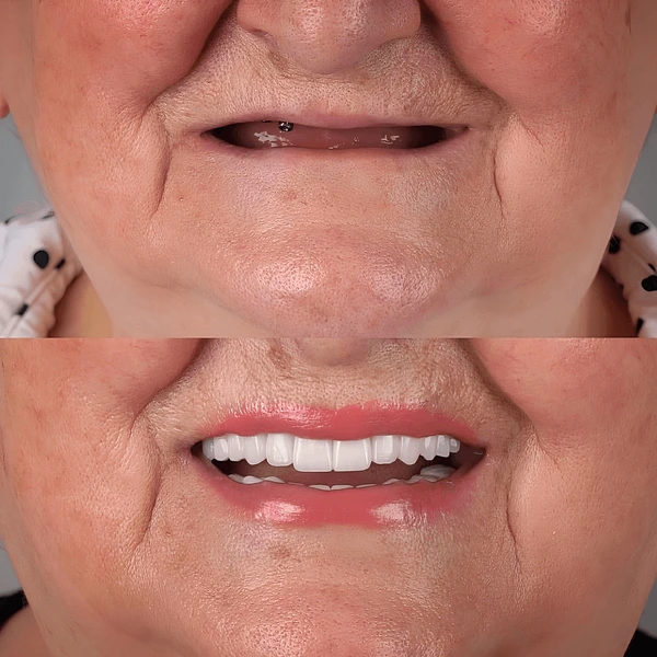 partial dentures removable root canal dentures composite resin inlay onlay bridge crowns Invisalign clear aligners teeth reshaping gummy smile botox bonding teeth whitening miami best dentist straight teeth white teeth perfect teeth beautiful smile veneers smile design veneers