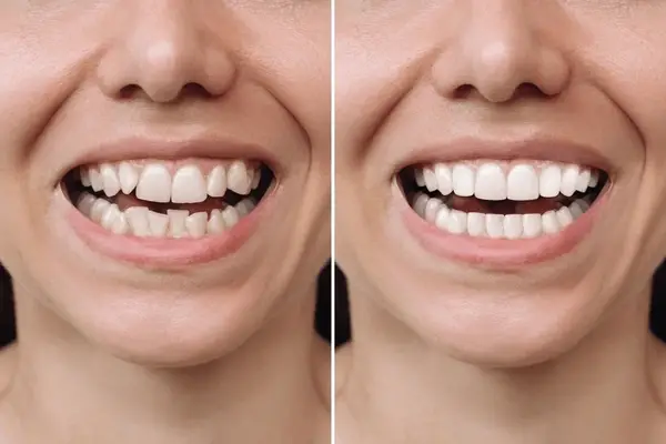 braces extraction tooth extract pulled out partial dentures removable root canal dentures composite resin inlay onlay bridge crowns Invisalign clear aligners teeth reshaping gummy smile botox bonding teeth whitening miami best dentist straight teeth white teeth perfect teeth beautiful smile veneers smile design veneers