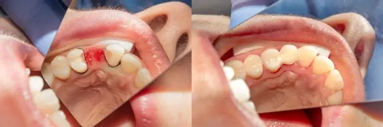extraction tooth extract pulled out partial dentures removable root canal dentures composite resin inlay onlay bridge crowns Invisalign clear aligners teeth reshaping gummy smile botox bonding teeth whitening miami best dentist straight teeth white teeth perfect teeth beautiful smile veneers smile design veneers