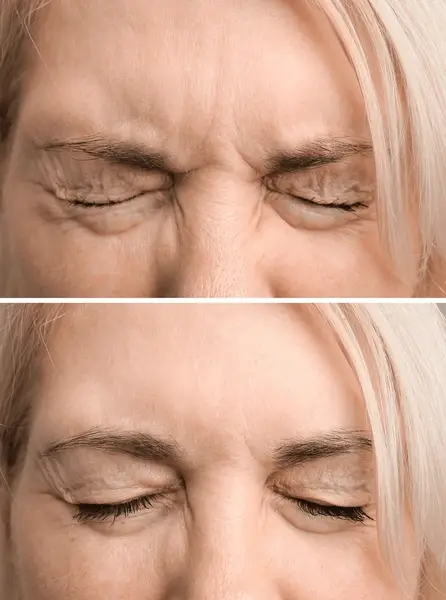 forehead-old-woman-before-after-600nw-2208146421.jpg