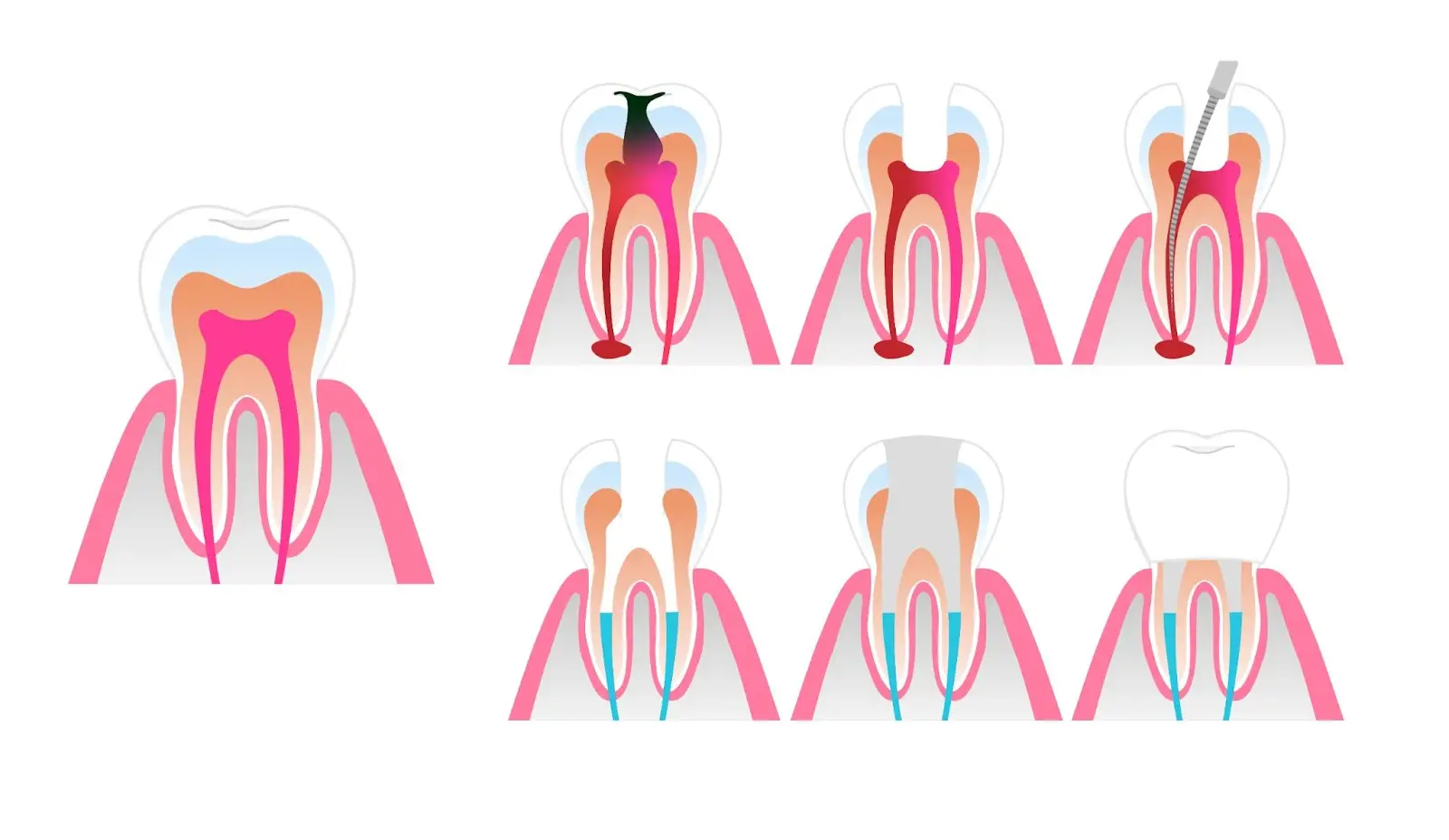 image-demonstrating-a-root-canal-procedure