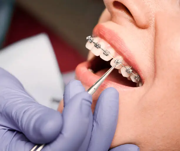 braces extraction tooth extract pulled out partial dentures removable root canal dentures composite resin inlay onlay bridge crowns Invisalign clear aligners teeth reshaping gummy smile botox bonding teeth whitening miami best dentist straight teeth white teeth perfect teeth beautiful smile veneers smile design veneers