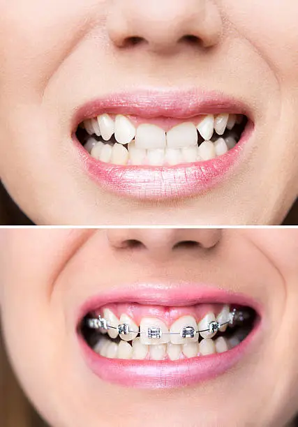 braces extraction tooth extract pulled out partial dentures removable root canal dentures composite resin inlay onlay bridge crowns Invisalign clear aligners teeth reshaping gummy smile botox bonding teeth whitening miami best dentist straight teeth white teeth perfect teeth beautiful smile veneers smile design veneers