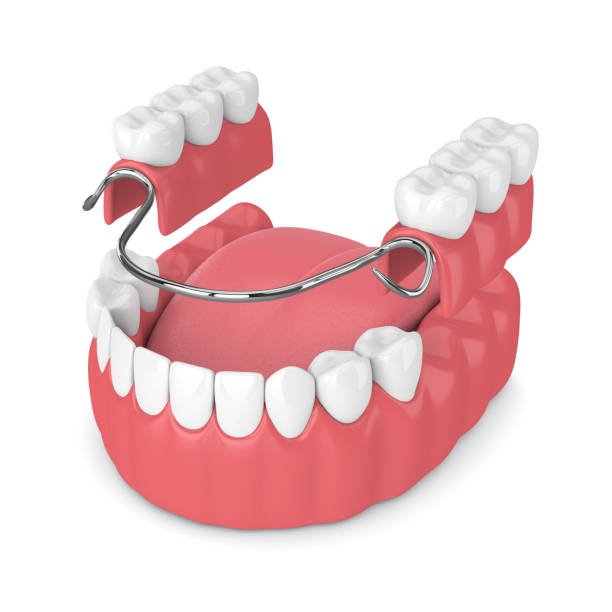 partial dentures removable root canal dentures composite resin inlay onlay bridge crowns Invisalign clear aligners teeth reshaping gummy smile botox bonding teeth whitening miami best dentist straight teeth white teeth perfect teeth beautiful smile veneers smile design veneers