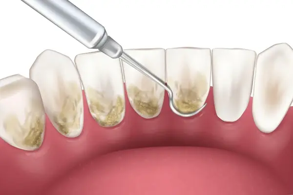 deep cleanning srp braces extraction tooth extract pulled out partial dentures removable root canal dentures composite resin inlay onlay bridge crowns Invisalign clear aligners teeth reshaping gummy smile botox bonding teeth whitening miami best dentist straight teeth white teeth perfect teeth beautiful smile veneers smile design veneers