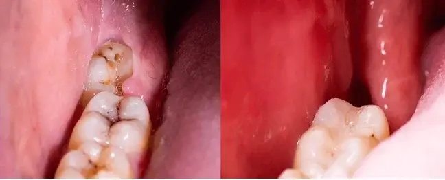 extraction tooth extract pulled out partial dentures removable root canal dentures composite resin inlay onlay bridge crowns Invisalign clear aligners teeth reshaping gummy smile botox bonding teeth whitening miami best dentist straight teeth white teeth perfect teeth beautiful smile veneers smile design veneers