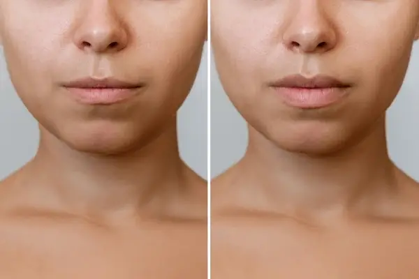result-lip-augmentation-cropped-shot-600nw-2236178589.jpg