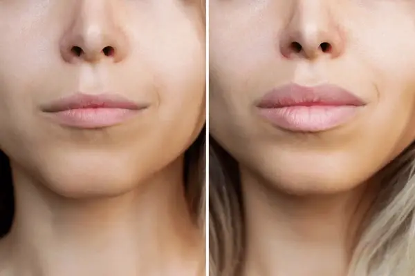 dermal fillers botox deep cleanning srp braces extraction tooth extract pulled out partial dentures removable root canal dentures composite resin inlay onlay bridge crowns Invisalign clear aligners teeth reshaping gummy smile botox bonding teeth whitening miami best dentist straight teeth white teeth perfect teeth beautiful smile veneers smile design veneers