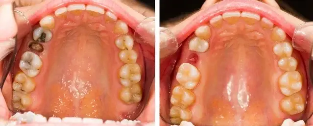 extraction tooth extract pulled out partial dentures removable root canal dentures composite resin inlay onlay bridge crowns Invisalign clear aligners teeth reshaping gummy smile botox bonding teeth whitening miami best dentist straight teeth white teeth perfect teeth beautiful smile veneers smile design veneers