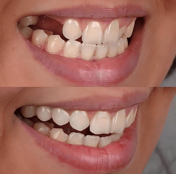 partial dentures removable root canal dentures composite resin inlay onlay bridge crowns Invisalign clear aligners teeth reshaping gummy smile botox bonding teeth whitening miami best dentist straight teeth white teeth perfect teeth beautiful smile veneers smile design veneers
