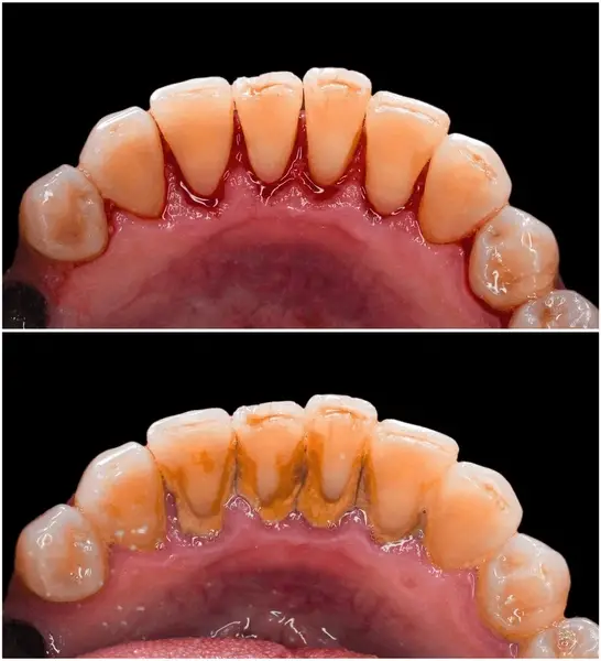 deep cleanning srp braces extraction tooth extract pulled out partial dentures removable root canal dentures composite resin inlay onlay bridge crowns Invisalign clear aligners teeth reshaping gummy smile botox bonding teeth whitening miami best dentist straight teeth white teeth perfect teeth beautiful smile veneers smile design veneers
