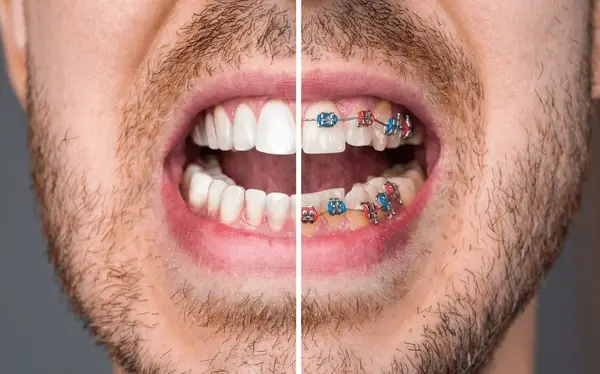 braces extraction tooth extract pulled out partial dentures removable root canal dentures composite resin inlay onlay bridge crowns Invisalign clear aligners teeth reshaping gummy smile botox bonding teeth whitening miami best dentist straight teeth white teeth perfect teeth beautiful smile veneers smile design veneers