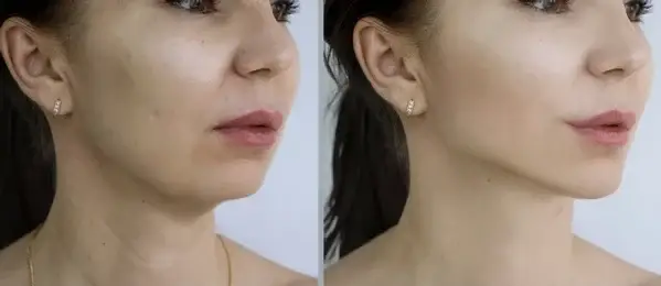 dermal fillers botox deep cleanning srp braces extraction tooth extract pulled out partial dentures removable root canal dentures composite resin inlay onlay bridge crowns Invisalign clear aligners teeth reshaping gummy smile botox bonding teeth whitening miami best dentist straight teeth white teeth perfect teeth beautiful smile veneers smile design veneers
