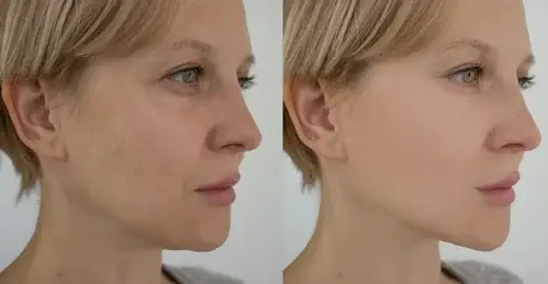 woman-face-wrinkles-before-after-260nw-2187487293.jpg